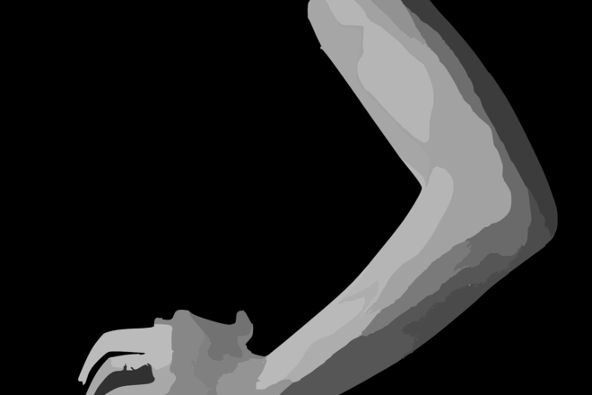¿Qué es epicondilitis o codo de tenista?